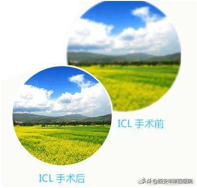 icl术后关注事项,icl术后用眼关注事项