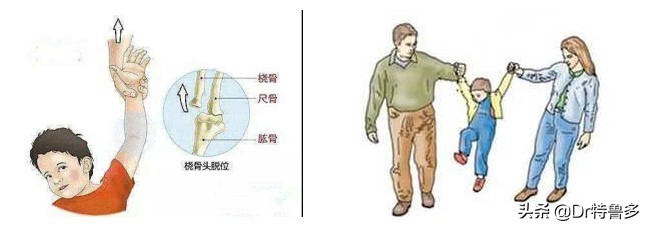 桡骨小头半脱位内旋外旋区别,桡骨小头半脱位复位收费标准