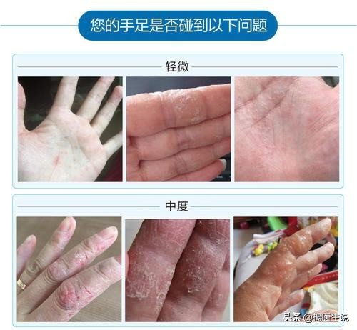 一到夏天手上长红疹痒什么原因,一到夏天手上起红疙瘩很痒怎么办