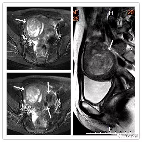 子宫肌瘤导致贫血怎么办,浆膜下子宫肌瘤会引起贫血吗