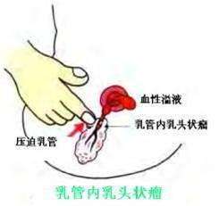 出现乳头血性溢液该怎么办？听听乳腺外科医生的建议