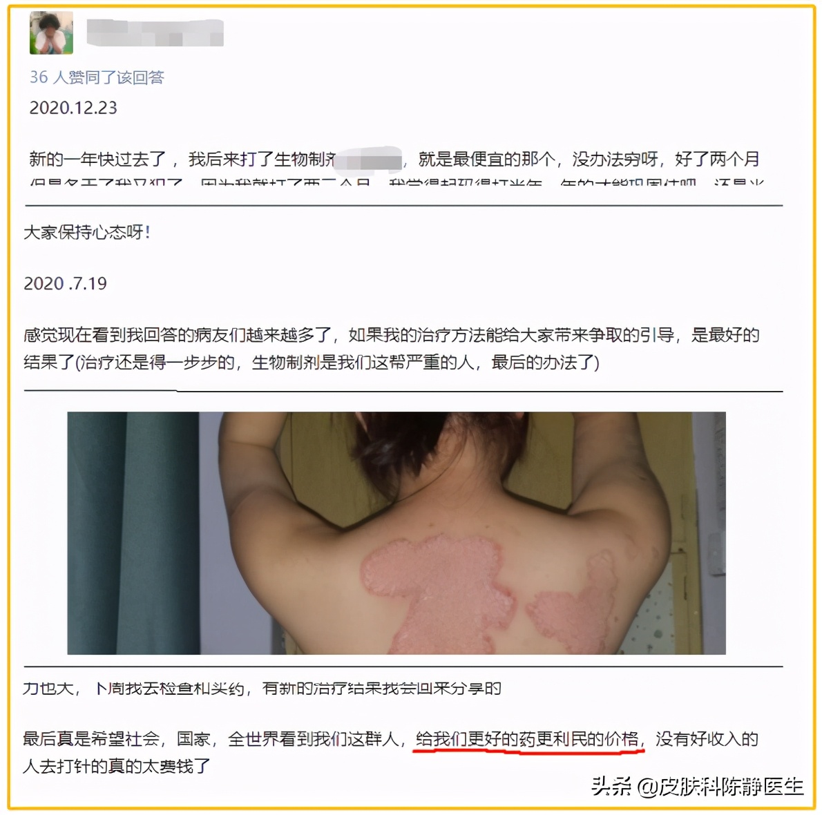 治疗牛皮癣银屑病进口生物制剂,牛皮癣最新生物制剂口服