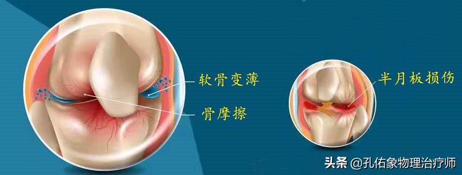 膝关节疼痛位置判断得了什么病,膝关节疼痛一般什么原因引起的