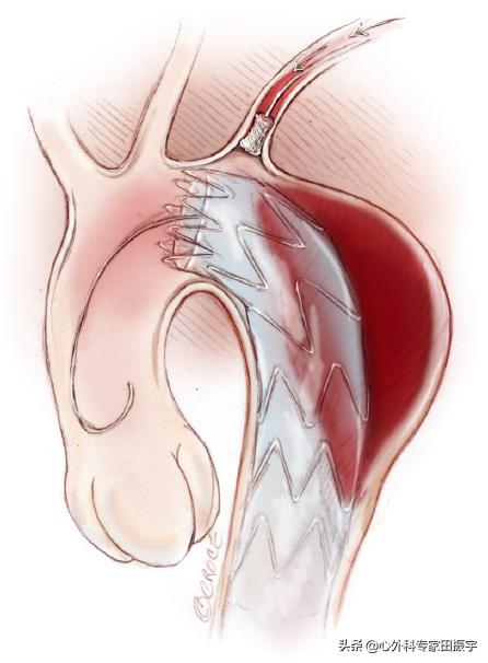 主动脉夹层破裂b型,急性主动脉夹层动脉瘤破裂
