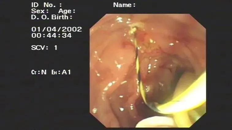 现在还存在蛔虫病吗,为何现在没人感染蛔虫了