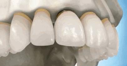 2000块的种植体你真的敢种吗？为什么会这么便宜，良心牙医告诉你