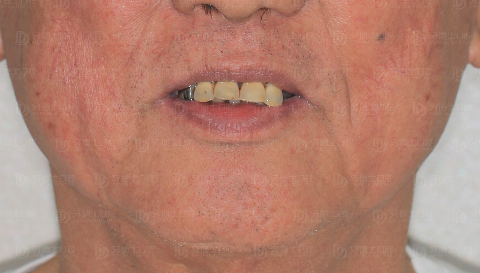 有牙根的缺牙不补,缺牙不补上面的牙掉下来