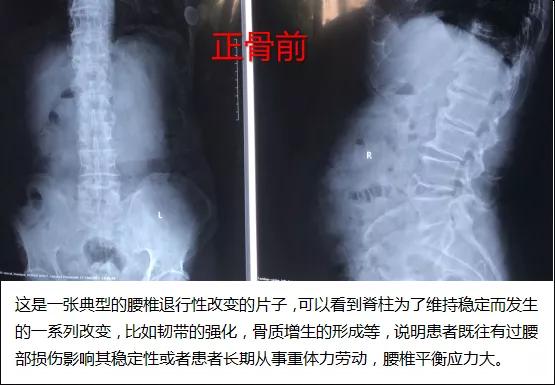 骨头不正会怎么样,老人骨头僵硬坐不稳