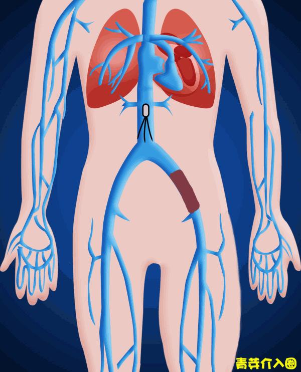 腿肿要警惕四种病,人的腿肿是什么病的前兆