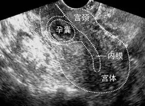 宫外孕早期保守治疗好还是手术好,怀孕初期预防宫外孕的运动锻炼