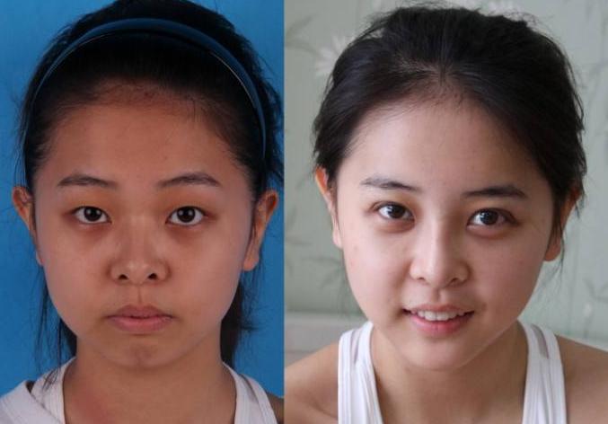 激光美白全身的步骤,激光美白可以美白多少