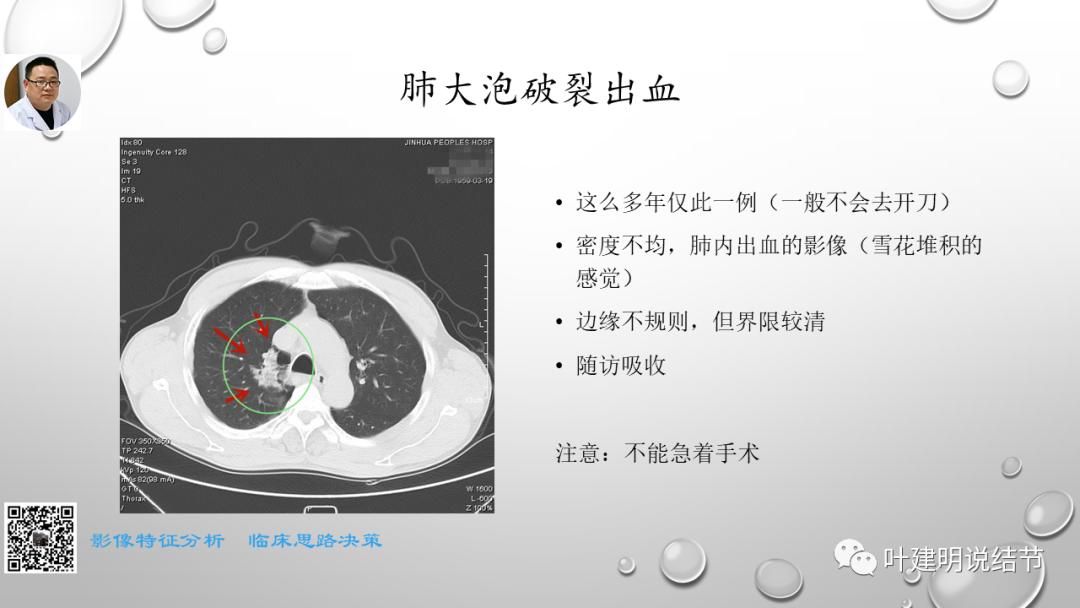 叶建明谈肺实性小结节视频,廖正银教授谈肺结节