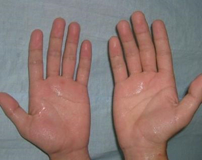 夏天手心汗多怎么办,夏天手心出汗有什么办法解决