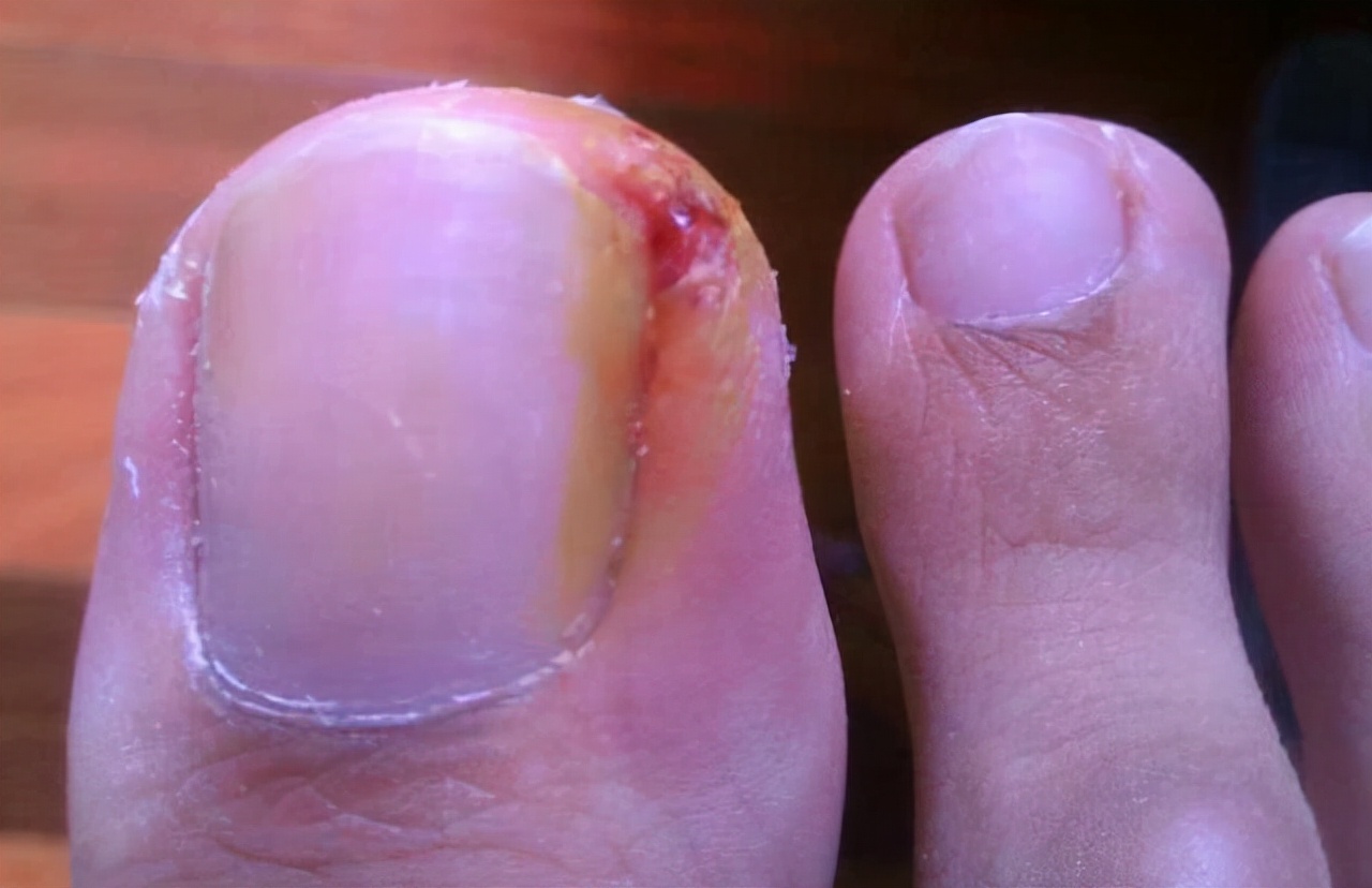 脚趾甲长进肉里会痛怎么办甲沟炎,脚趾甲老往肉里钻一碰还疼