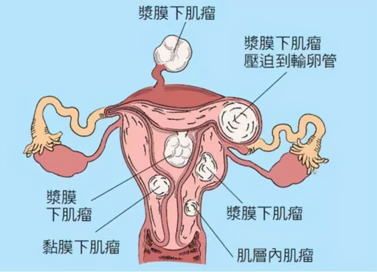 40岁切除子宫很后悔,子宫千疮百孔