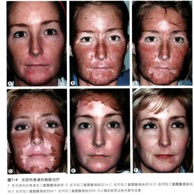 水杨酸和果酸的护肤区别,水杨酸和果酸护肤效果一样吗