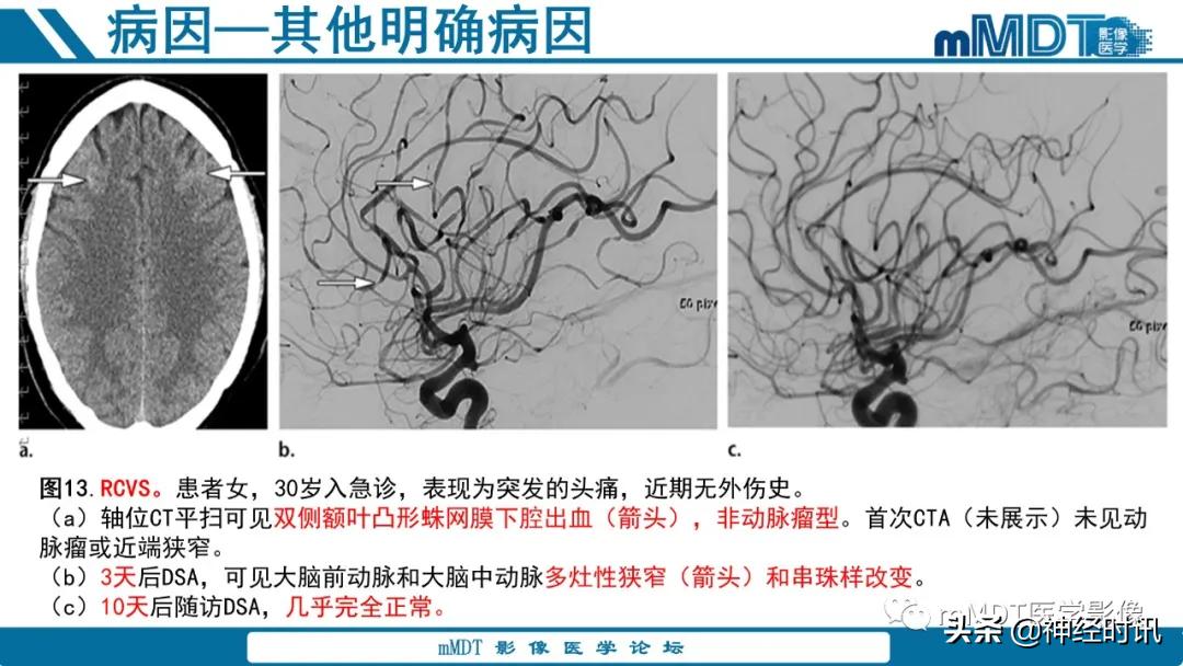 缺血性脑卒中护理课件,缺血性脑卒中讲课ppt