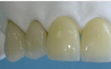 二氧化锆牙齿能做ct和核磁共振吗,氧化锆全锆牙冠能做核磁共振吗