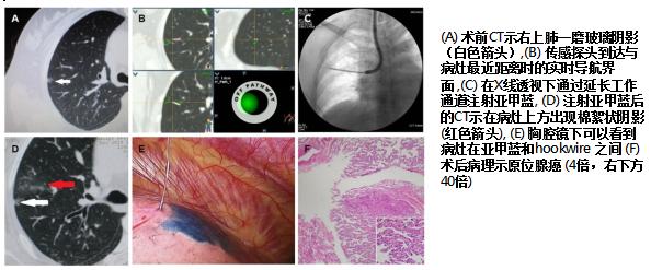 全球对肺癌治疗的最有效最新技术,肺癌的支气管镜介入治疗
