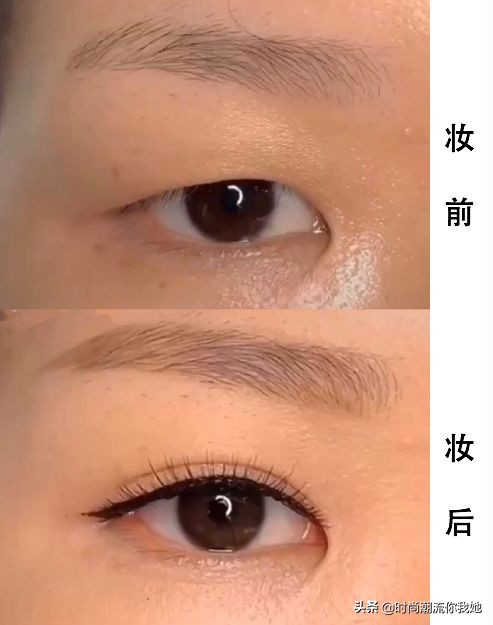 单眼皮凸嘴素人改造,肿眼泡整容成功案例