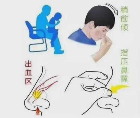 小孩流鼻血快速止血的特效土方,鼻子经常流鼻血有什么好土方治