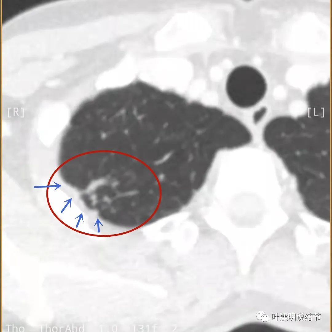 临床诊断孤立性肺结节,空洞型结节一般是什么性质