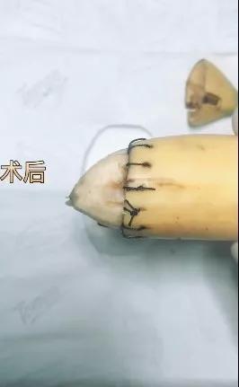香蕉割包皮，洋葱剖腹产？这是我见过最秀的医生
