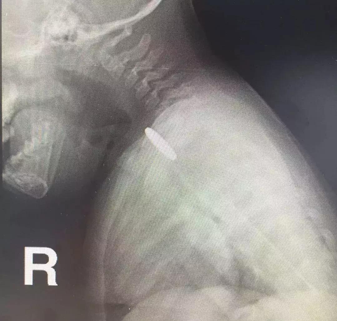 小孩先天性食道被塞什么引起的,一岁女童胃部被撑破