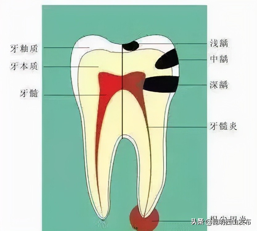 牙齿上有黑点可怕吗,牙齿上有小黑点原来这么可怕