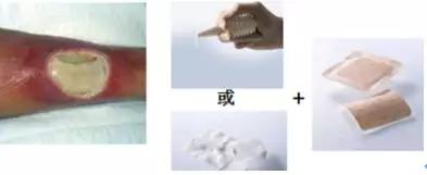 压疮敷料的选择及使用,褥疮敷料的正确使用方法
