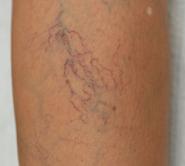 “医生，我腿上一条条青筋是怎么回事，像蜘蛛网、像蚯蚓”