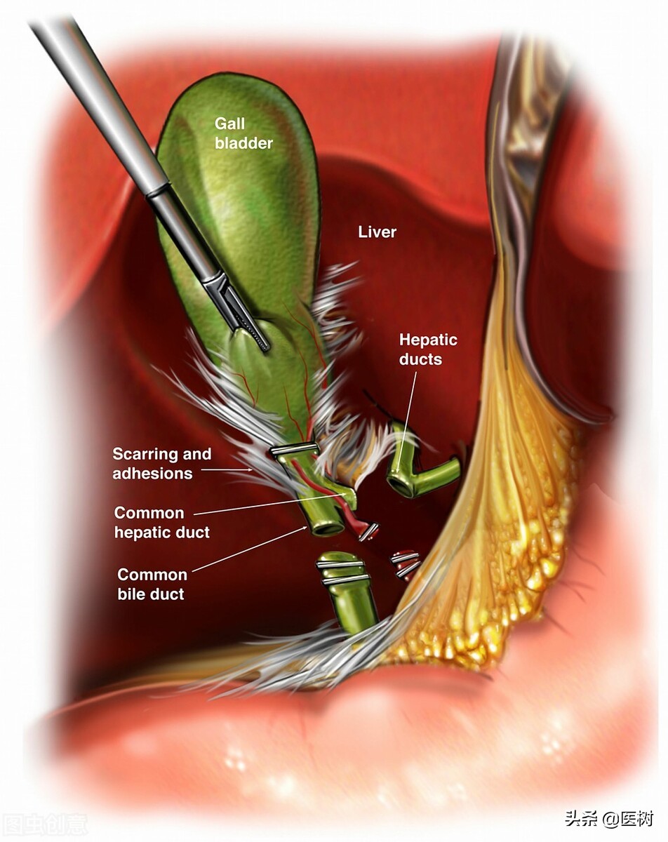 胆结石手术后可以预防胆管结石吗,胆囊结石和胆结石哪个严重一点