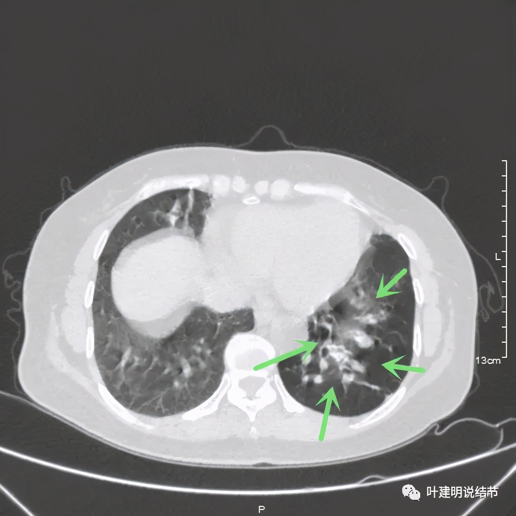 这样的实性结节伴小空洞会是肺癌吗？