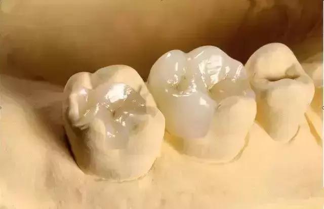 牙齿烂了一半为什么不能补牙,牙齿缺了一半补牙要多少钱