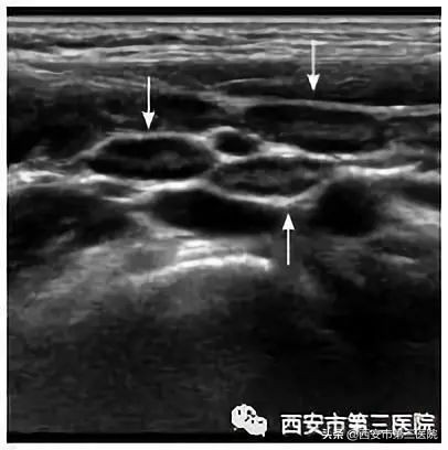 孩子肠系膜淋巴结炎肚子疼怎么办,儿童肠系膜淋巴结炎肚子疼严重吗