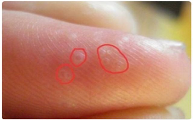 一到夏天，手上就长小水疱？汗疱疹别挑破，艾灸止痒防复发