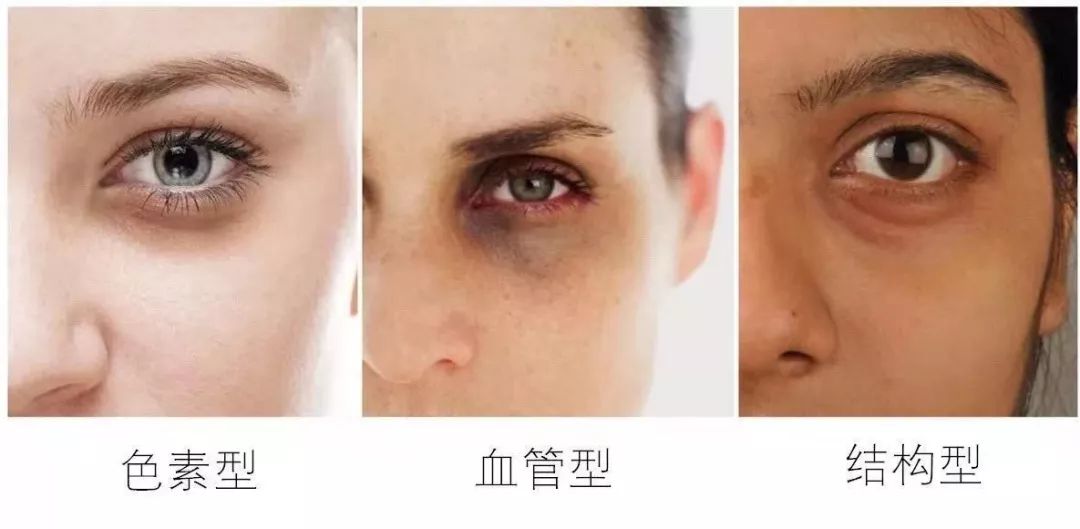 没有熬夜也有黑眼圈怎么办,没有熬夜黑眼圈怎么去除