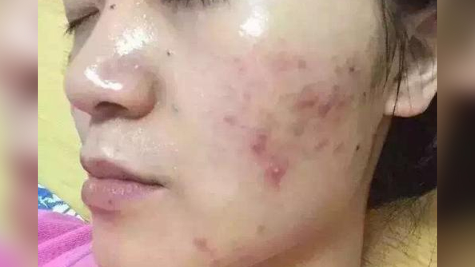 t区油爱长痘怎么办,40多了还长痘痘要怎么调理