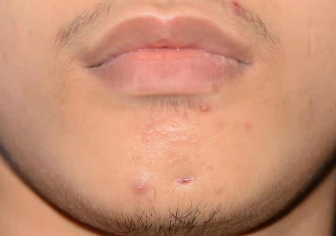 牙齿坏死和下巴长痘有关,下巴长出瘤子