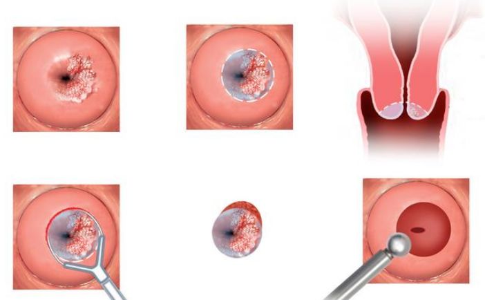 宫颈癌“初期”，子宫发出3次“警告”，不止是简单的妇科炎症