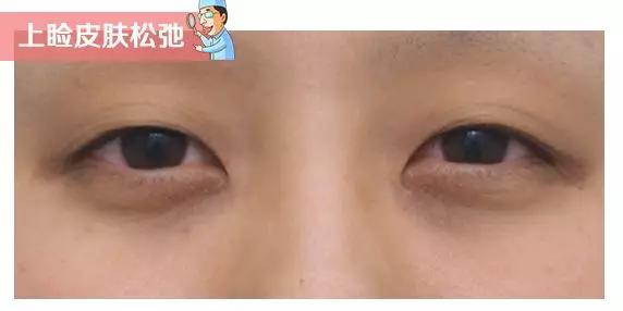 24岁有泪沟法令纹眼窝凹陷,如何改善黑眼圈泪沟眼袋法令纹