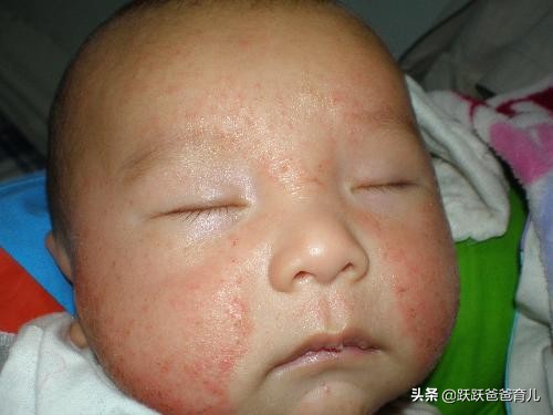 治疗湿疹的最好土办法除根,治疗湿疹图片