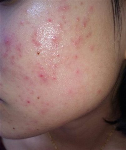 原来痘痘跟颜值没关系,原来痘痘是突然长出来的