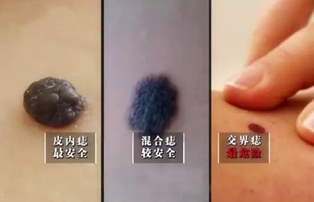 每个人身上都有很多痣么,每个人都有一颗痣好不好