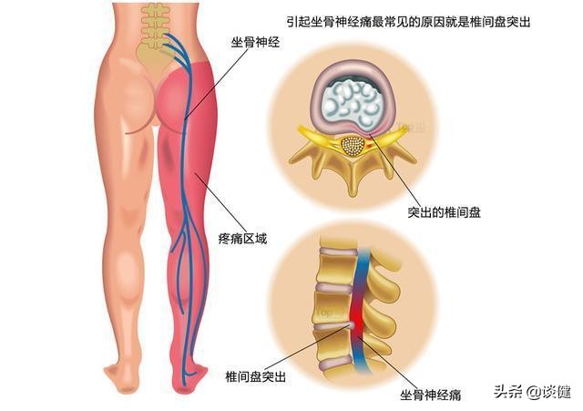 坐骨神经疼痛吃药不见轻,坐骨神经痛中医也治不好吗