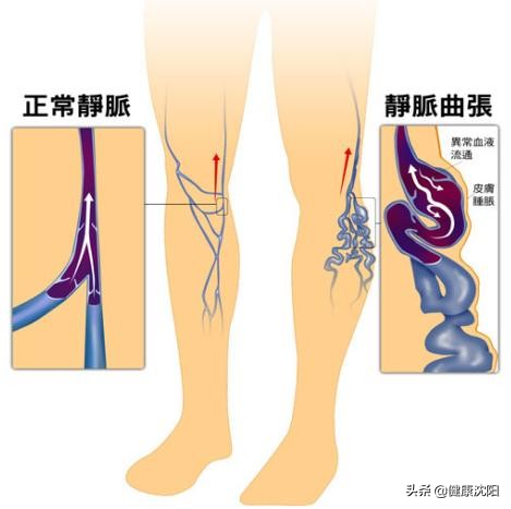 山东开展chiva治疗静脉曲张,chiva是微创治疗静脉曲张吗
