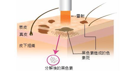 激光祛疤真的有效吗多少钱,激光祛疤痕是智商税吗
