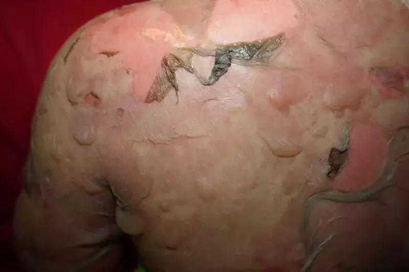 孩子身上莫名出现紫块,孩子身上起紫斑是怎么回事