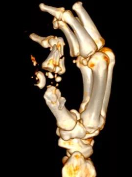 手指被机器绞掉肉后怎么恢复,右手全部被机器绞断算几级伤