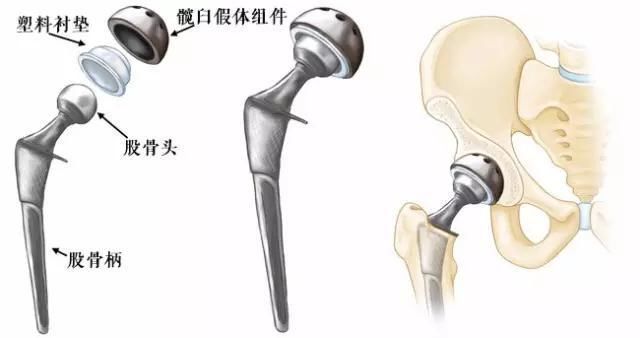 老人髋骨置换术后脱位如何处理,90岁老人摔断髋关节怎么办